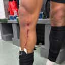Imagem de visualização para Athletico-PR divulga foto da perna de Cuello após entrada dura de Caíque, do Juventude