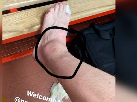 Article image:Photo: Donny van de Beek shows off a nasty looking ankle injury after Man United’s victory over Southampton