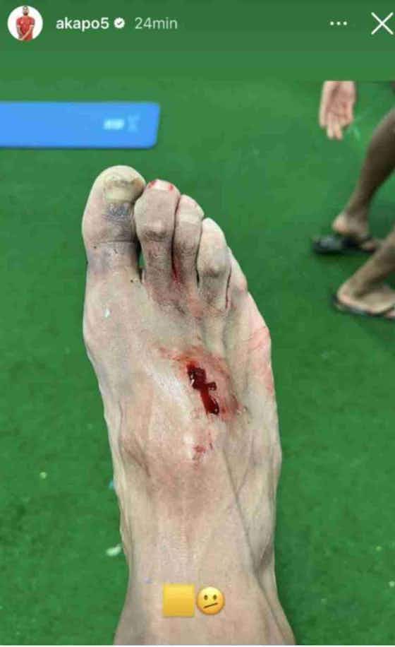 Imagen del artículo:La dolorosa imagen del pie de Akapo tras la brutal entrada de Hazard