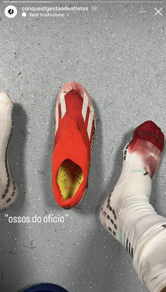 Immagine dell'articolo:Infortunio Felipe Anderson, l’agenzia del brasiliano mostra la ferita rimediata con la Juve- FOTO